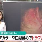 怖い！いつも使っているヘアカラー白髪染めでもアレルギー症状＞＞その予防策とは＞＞